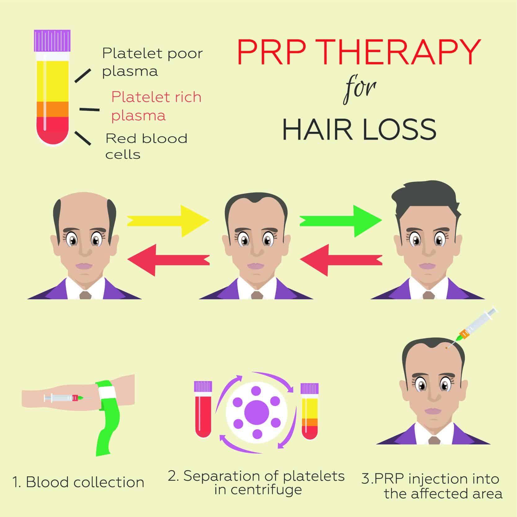 What Is PRP Plus: Is Platelet Rich Plasma for Hair Loss Beneficial ...